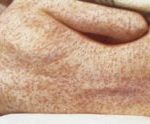 Back_of_female_with_measles_Wellcome_L0032962-825x340-1k30da16k1jg-300x124-1