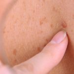 el-teledermatoscopio-mejora-el-diagnostico-de-cancer-de-piel-5945_620x368-1