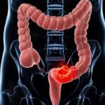 cancer-colon-sintomas-kMaG-620x34940abc