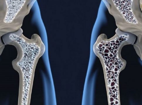 Día Mundial de la Osteoporosis