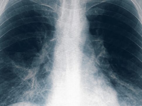 Neumonía bilateral por legionella