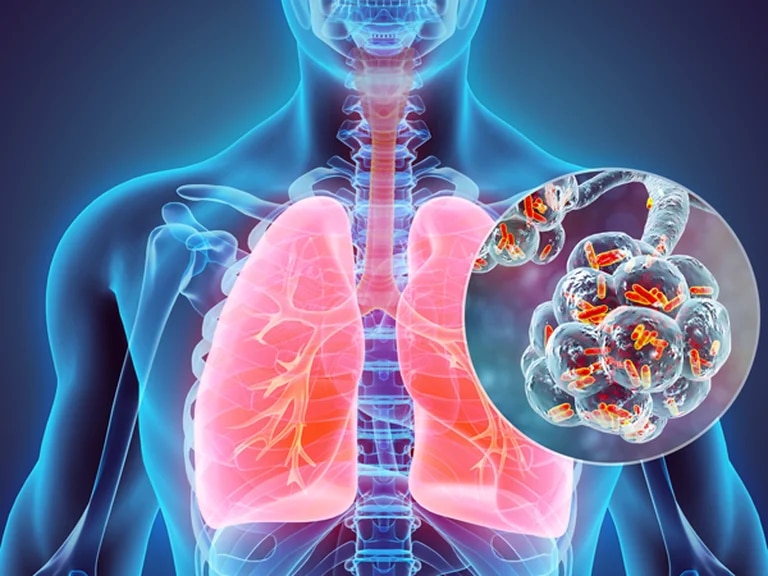 Qué es la Legionella