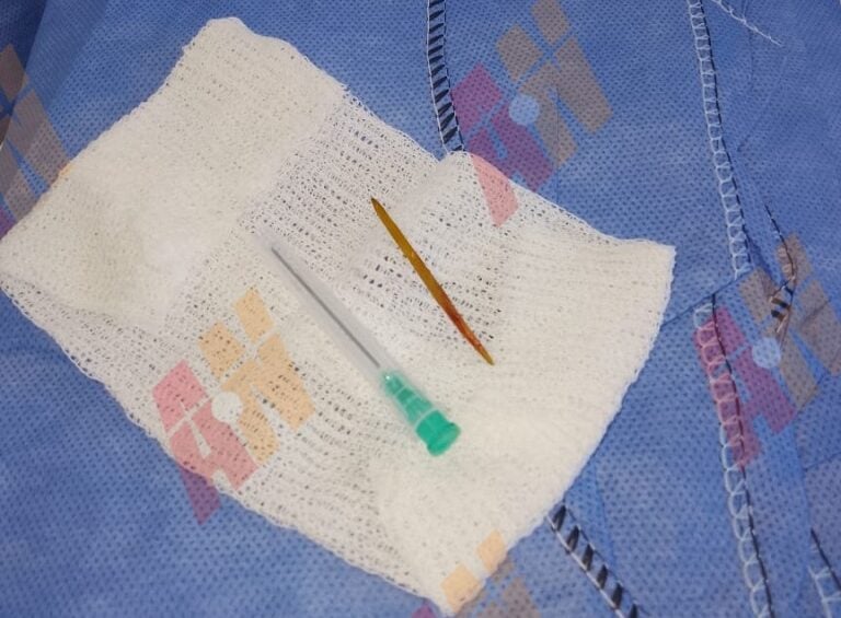 Se tragó un escarbadientes