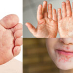 Sindrome-pie-boca-mano