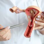 cancer-de-cuello-uterino
