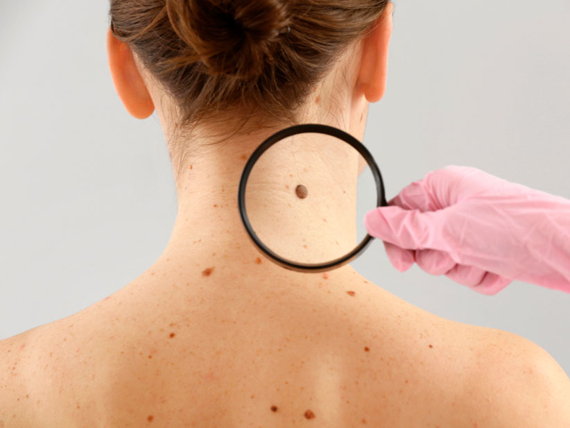 Día Mundial del Melanoma