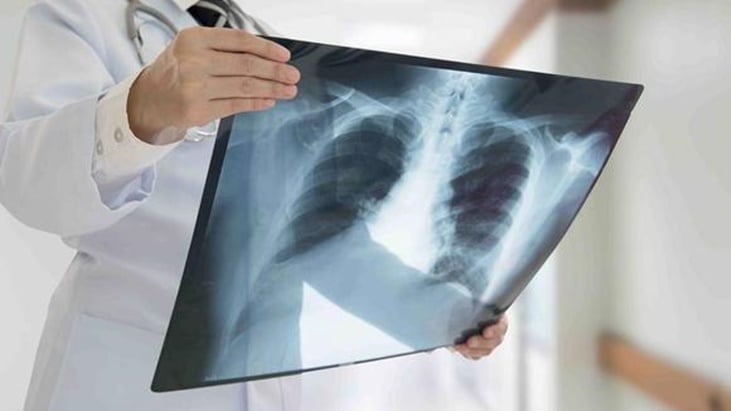 casos de tuberculosis en jóvenes